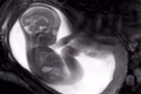 ti; ca. . Gfanon x ray womb v1 1